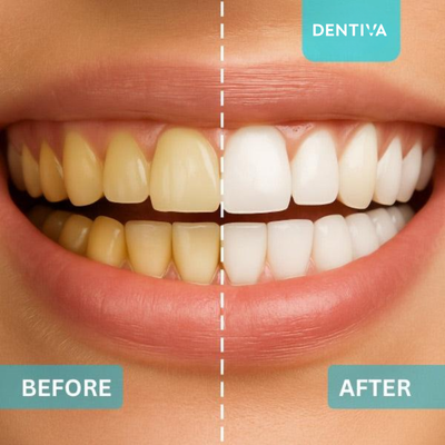 Blanqueador dental de carbón Dentiva™ 